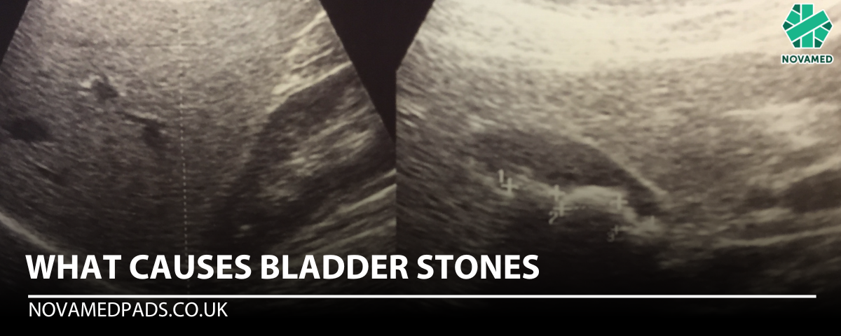 What Causes Bladder Stones - Novamed (Europe) ltd