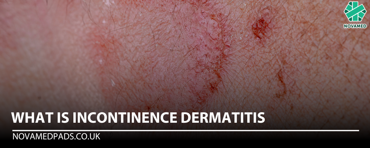 What Is Incontinence Dermatitis - Novamed (Europe) ltd